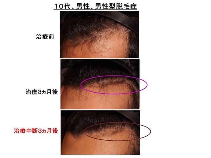 円形脱毛症　病院""